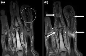 Psoriatic Arthropathy Affecting the Fingers SimpleMed Psoriatic Arthropathy Affecting the Fingers SimpleMed