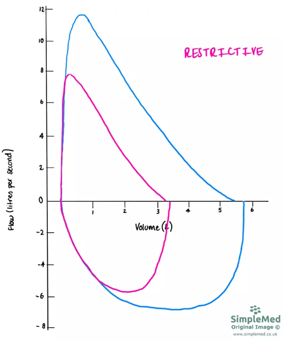 Restrictive Flow Volume Curve SimpleMed Restrictive Flow Volume Curve SimpleMed