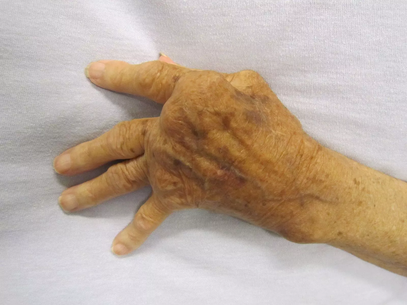 Rheumatoid Arthritis Hand SimpleMed Rheumatoid Arthritis Hand SimpleMed