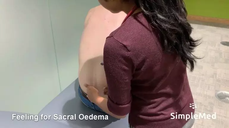 Sacral Oedema SimpleMed Sacral Oedema SimpleMed