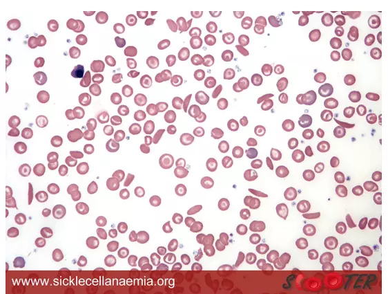 Sickle Cell Anaemia Blood Smear SimpleMed Sickle Cell Anaemia Blood Smear SimpleMed
