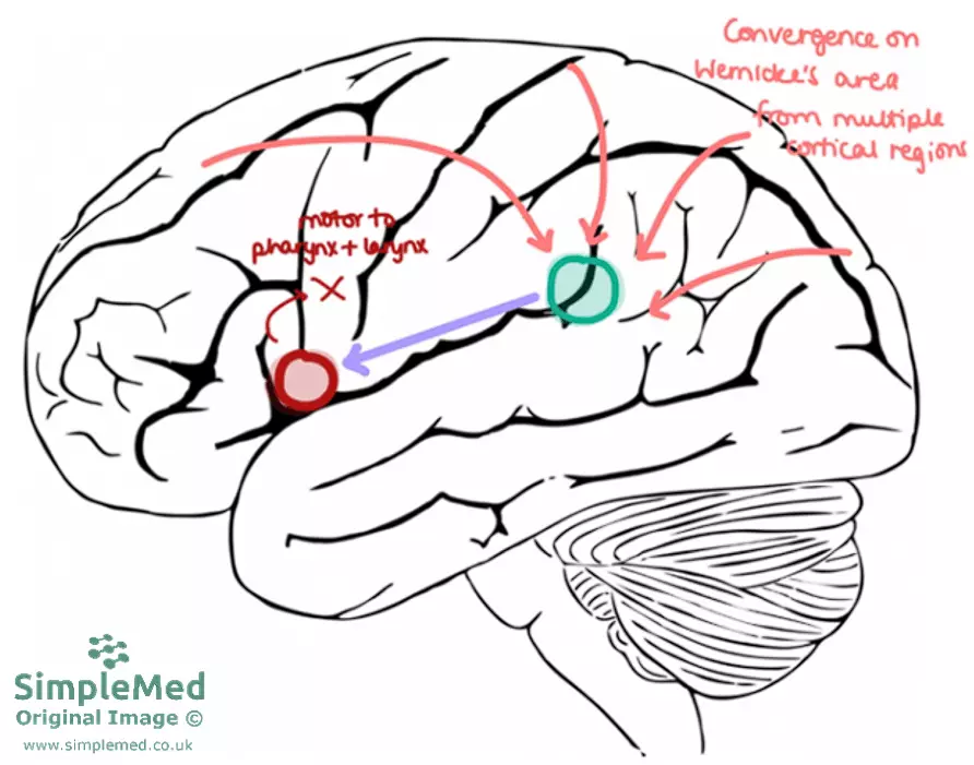 Pathway for Speaking a Though Word SimpleMed Pathway for Speaking a Though Word SimpleMed