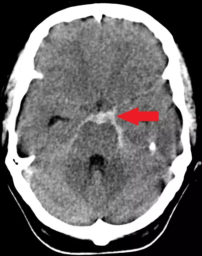 Subarachnoid Haemorrhage on a CT Scan SimpleMed