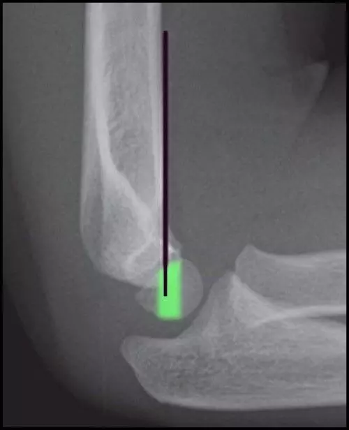 Supracondylar Fracture of the Distal Humerus X-Ray SimpleMed Supracondylar Fracture of the Distal Humerus X-Ray SimpleMed