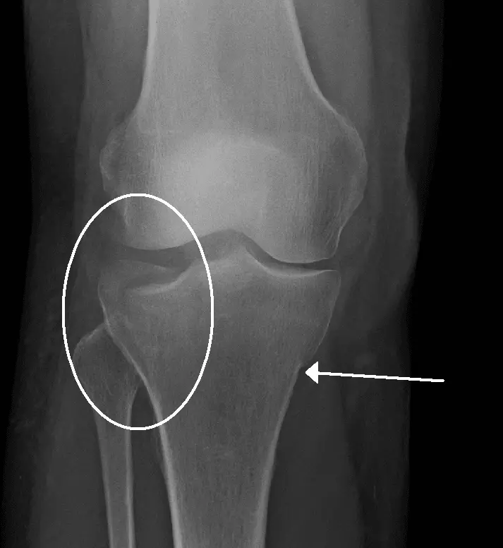 Tibial Plateau Fracture X-Ray SimpleMed Tibial Plateau Fracture X-Ray SimpleMed