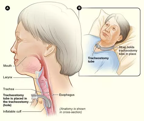 Creation of a Tracheostomy SimpleMed Creation of a Tracheostomy SimpleMed