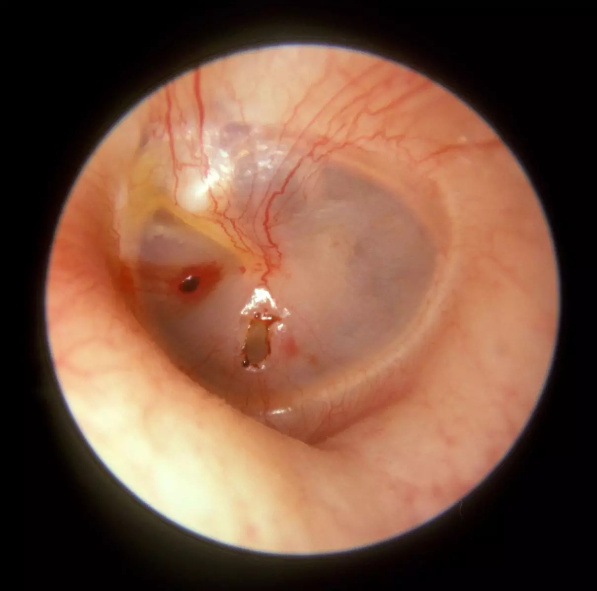 Traumatic Perforation of the Tympanic Membrane SimpleMed