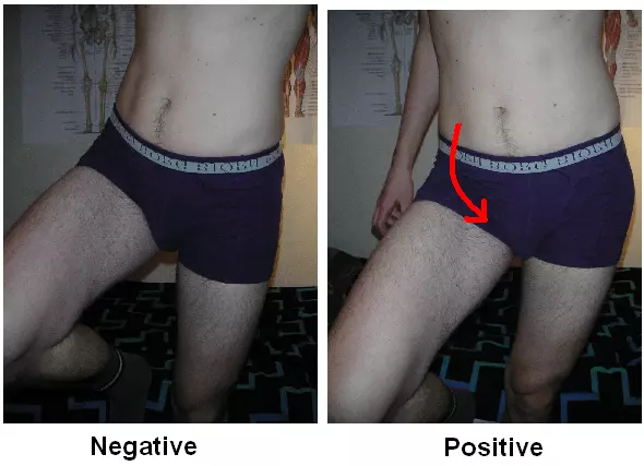 Trendelenburg's Sign SimpleMed Trendelenburg's Sign SimpleMed