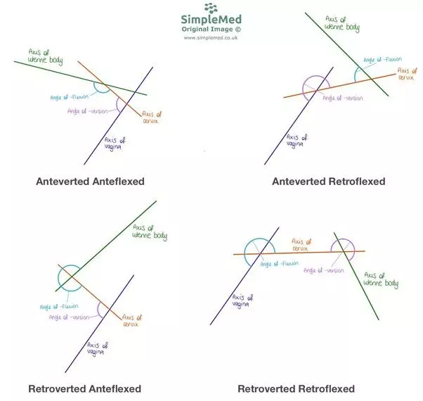 Types of Retroversion and Retroflexion SimpleMed Types of Retroversion and Retroflexion SimpleMed