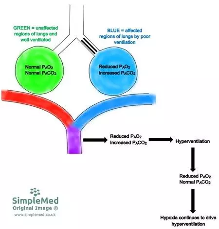 Ventilation Perfusion Mismatch due to Poor Ventilation SimpleMed Ventilation Perfusion Mismatch due to Poor Ventilation SimpleMed