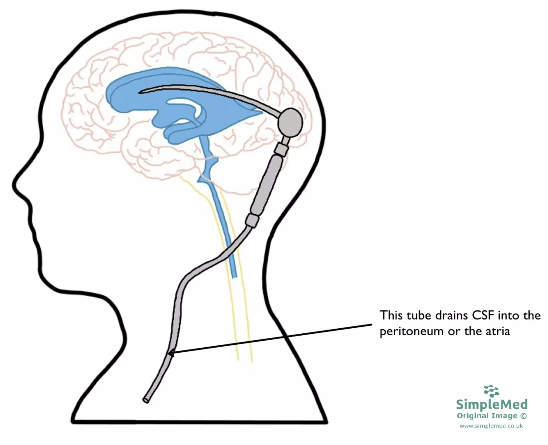 Ventricular Shunt for CSF Drainage SimpleMed