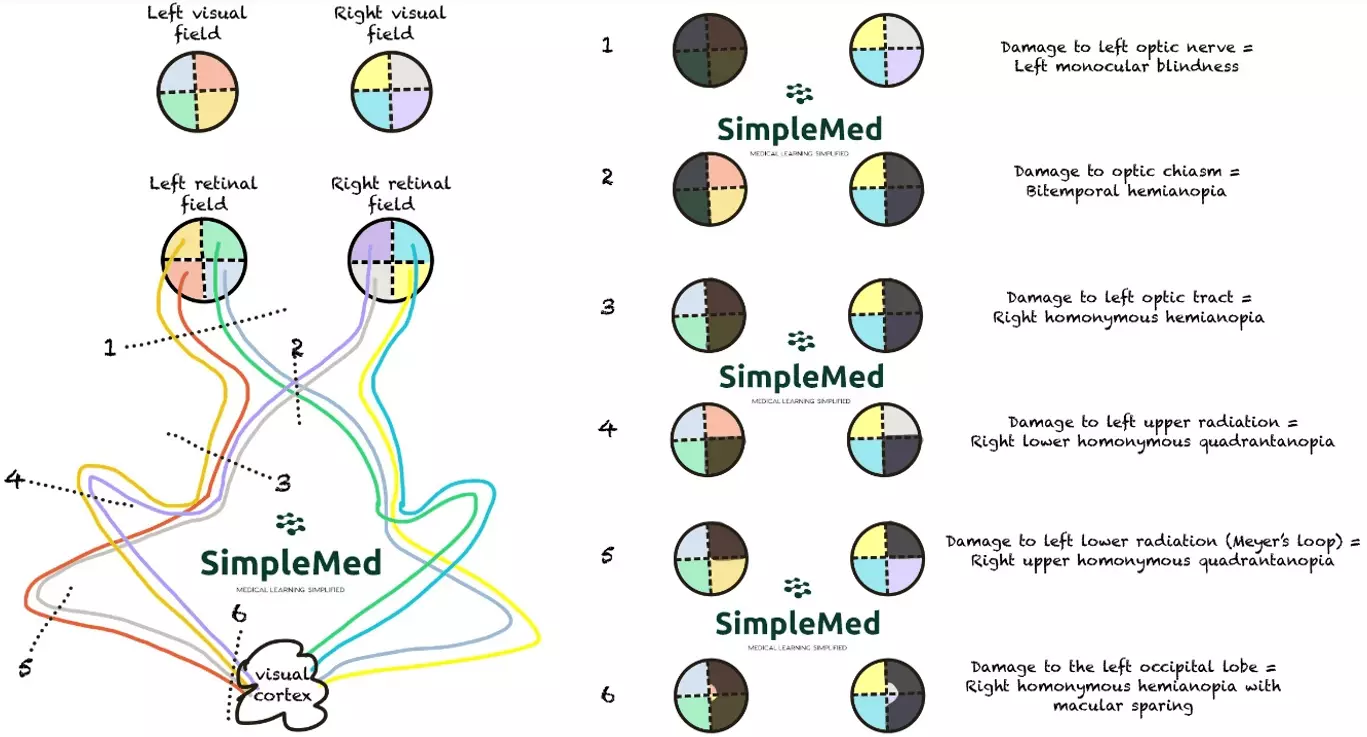 Visual Field Defects and Visual Field Pathway SimpleMed
