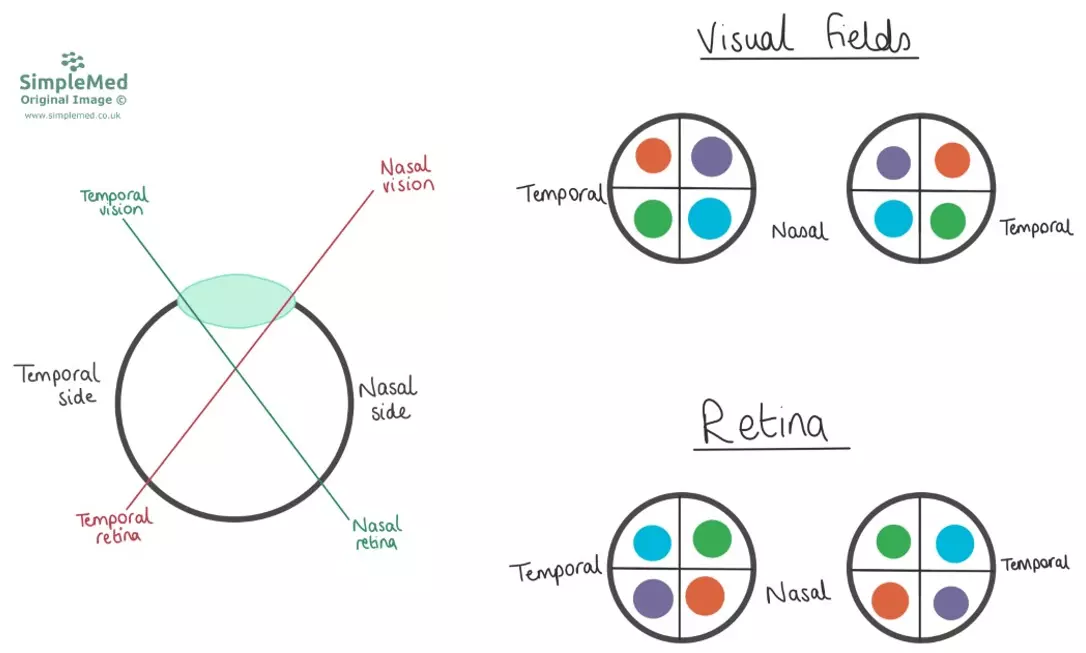 Visual Fields SimpleMed Visual Fields SimpleMed