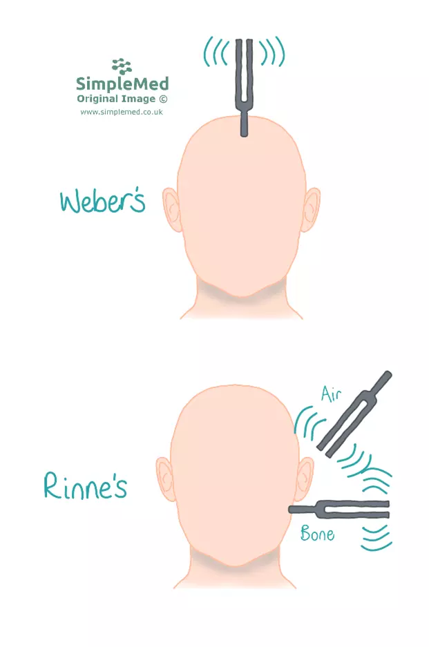 Weber's and Rinne's Test SimpleMed Weber's and Rinne's Test SimpleMed