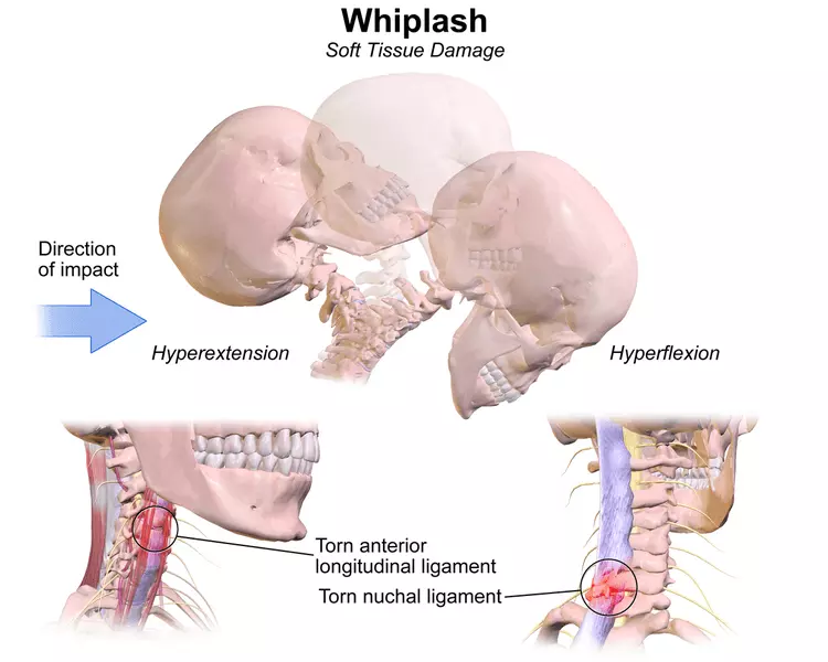 Whiplash SimpleMed Whiplash SimpleMed